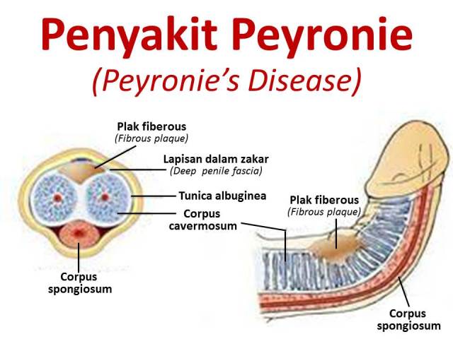 gambar penyakit peyronie dan keterangannya