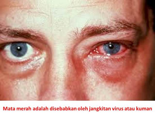 Mata merah adalah penyakit