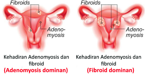 (INFO WANITA) Adenomyosis : Gejala, Penyebab dan Faktor Risiko