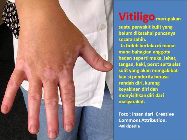 (INFO) Vitiligo : Penyakit kulit yang menghodohkan si penderita